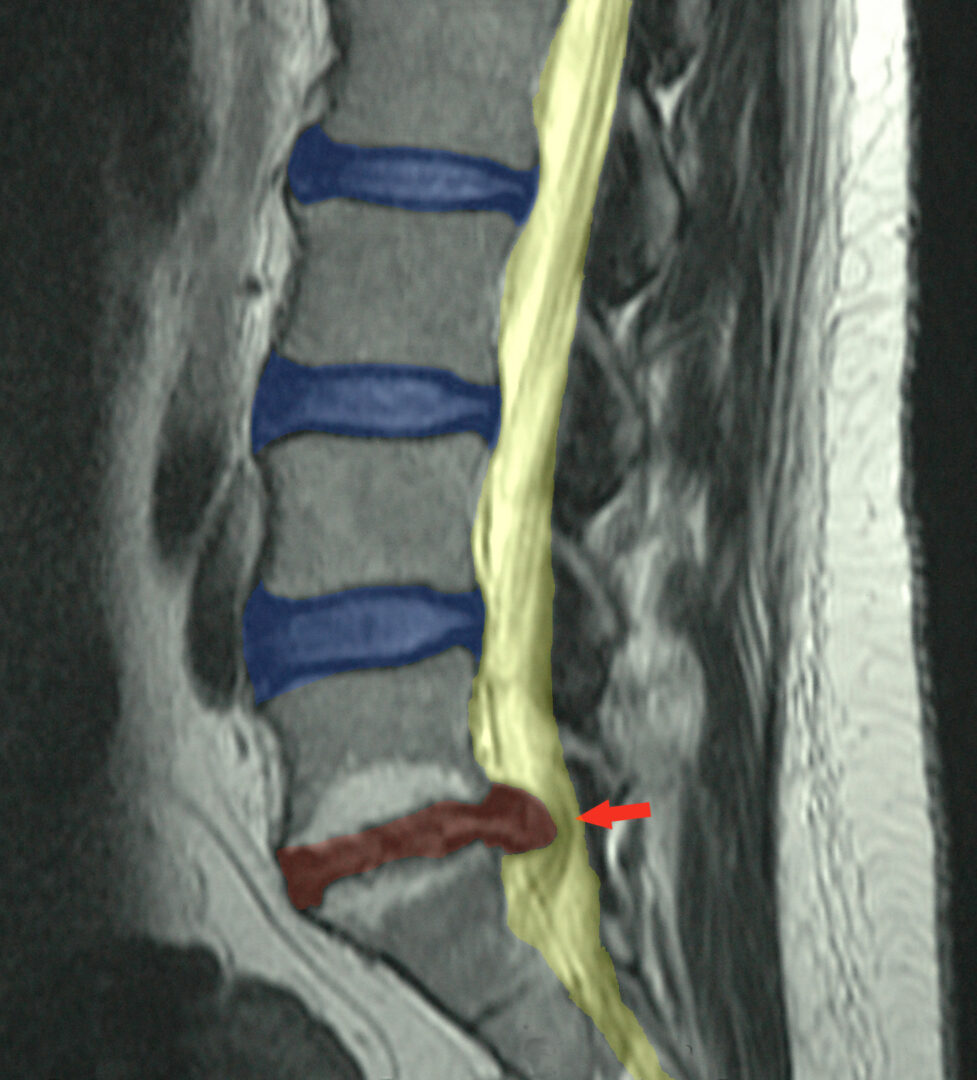 Herniated Lumbar Disc Mri